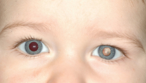 ojos de bebe con retinoblastoma